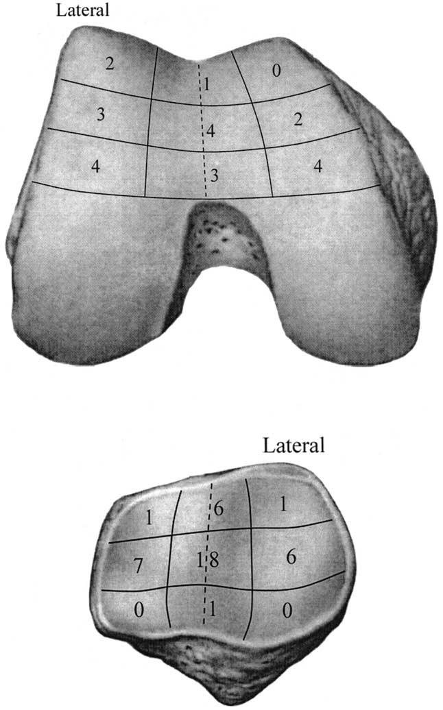 496 T. L. Boegård et al.: Cartilage defects of the patellofemoral joint Fig. 3.