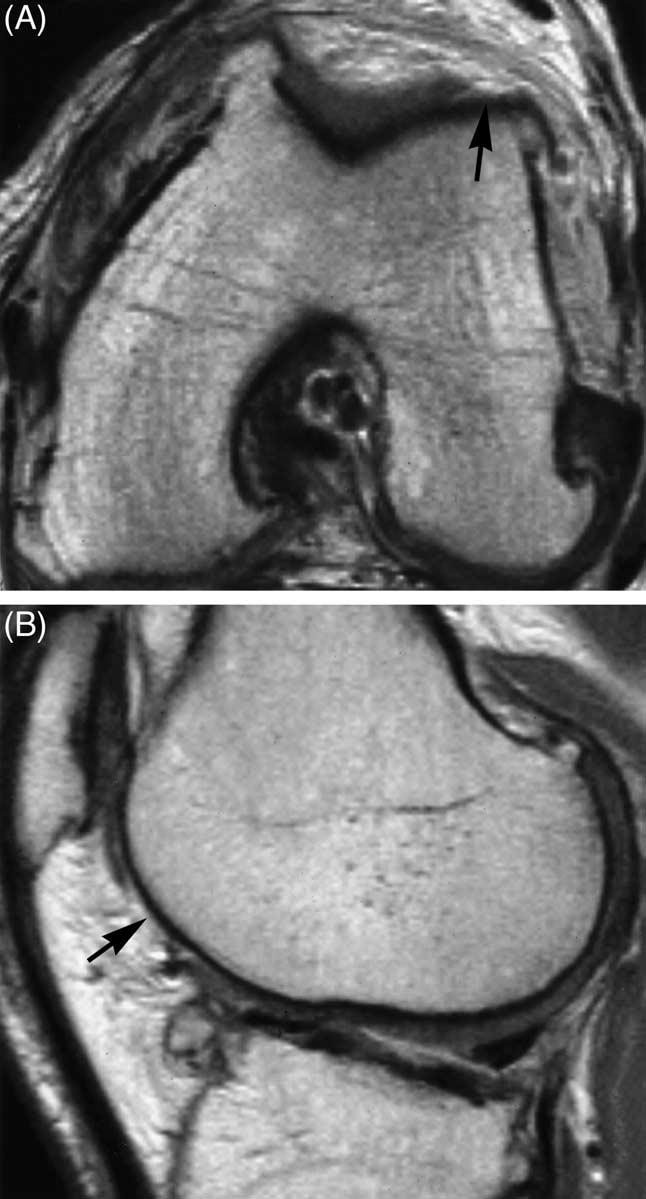 Osteoarthritis and Cartilage Vol. 11, No. 7 497 Fig. 5.