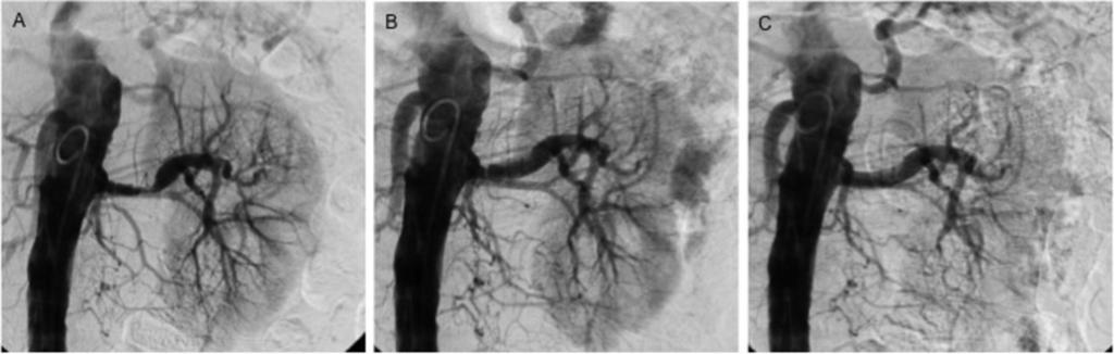 Fig. 7: Figure 7: 37 year old male patient with arterial hypertension and renal failure (hemodialysis since three weeks).