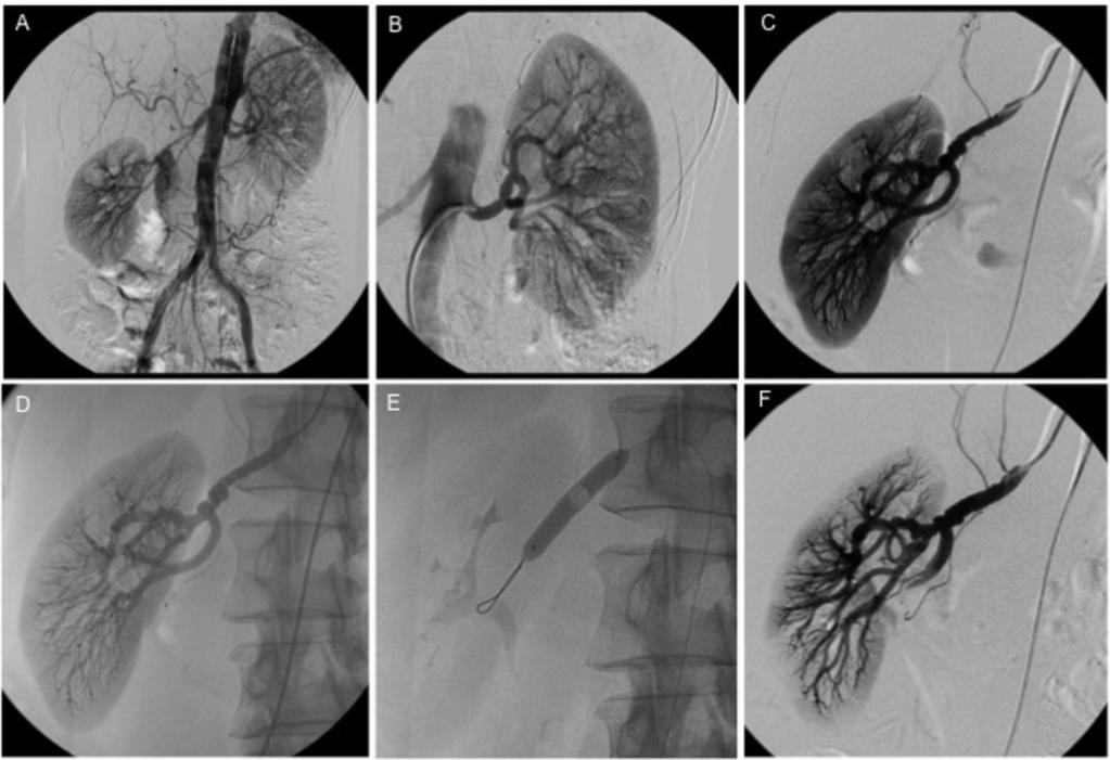 In addition to a high grade stenosis in the middle portion of the left renal artery total occlusion of the right renal artery can be appreciated.