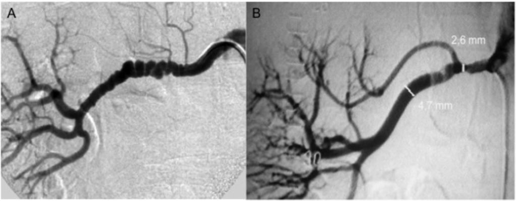 Fig. 5: Figure 5: Digital subtraction angiography (DSA) in a patient with media type FMD.