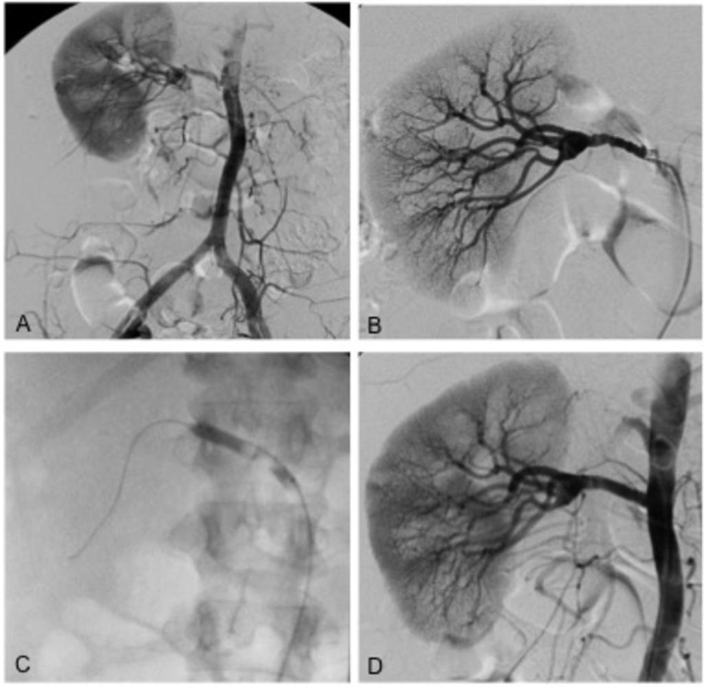 Fig. 6: Figure 6: 43 year old female patient with arterial hypertension and status post nephrectomy on the left side due to reflux nephropathy.