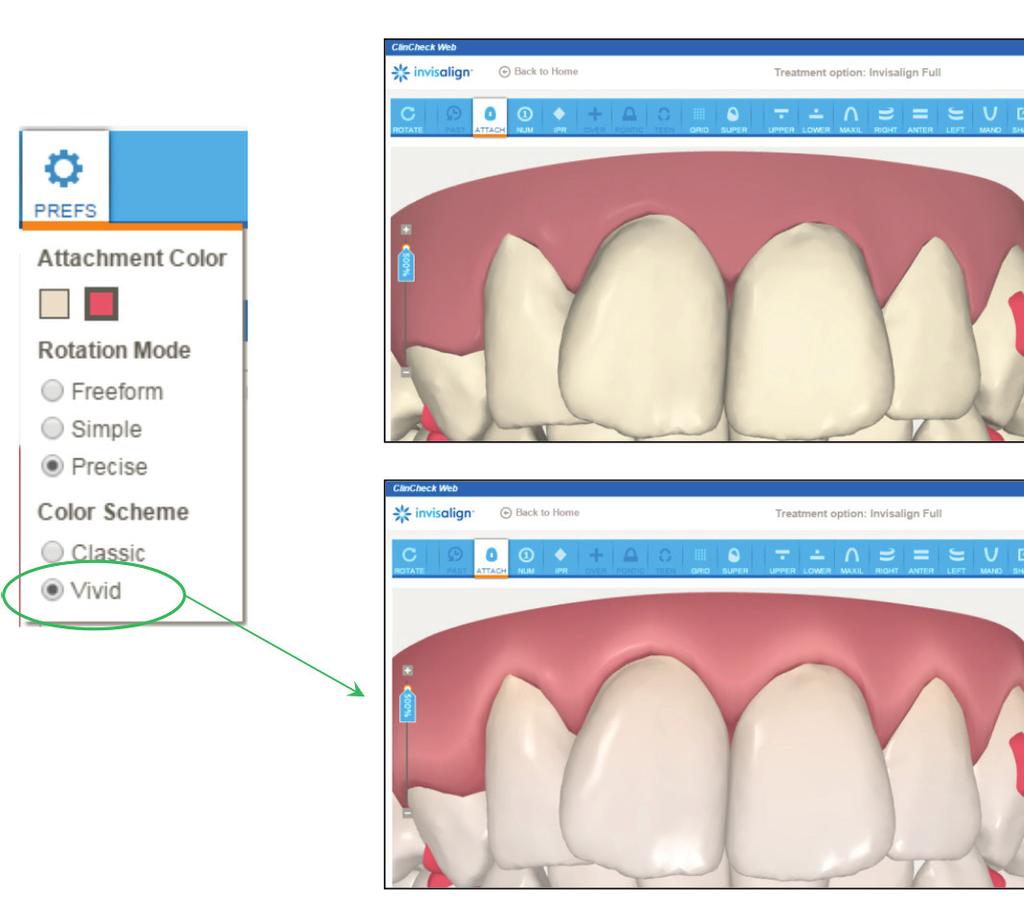 Improvements of ClinCheck Web. Improved Rendering (Color Scheme) Option. In ClinCheck Web, the color scheme can be modified for an improved rendering of the teeth and gingiva.