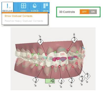 Improvements of ClinCheck Pro with 3D Controls. 3D Control Tool activated with open panes.