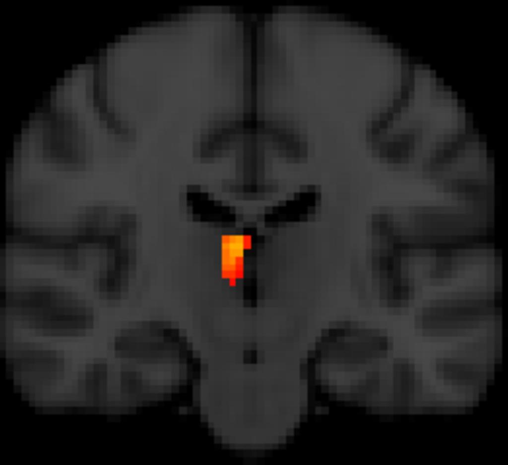 Fig. 1: VBM results: increased gray matter density (red-yellow)