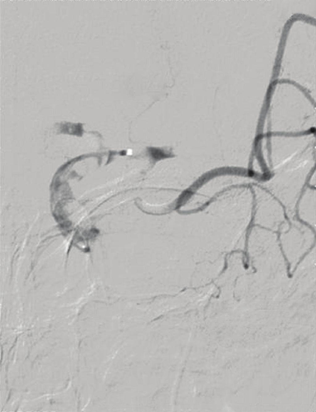 after retraction of the pcr with thrombus left in the M1 segment; (e) and (f) TICI 2a (TIMI 2) reperfusion after second passage with the pcr and administration of 4 mg intraarterial rtpa