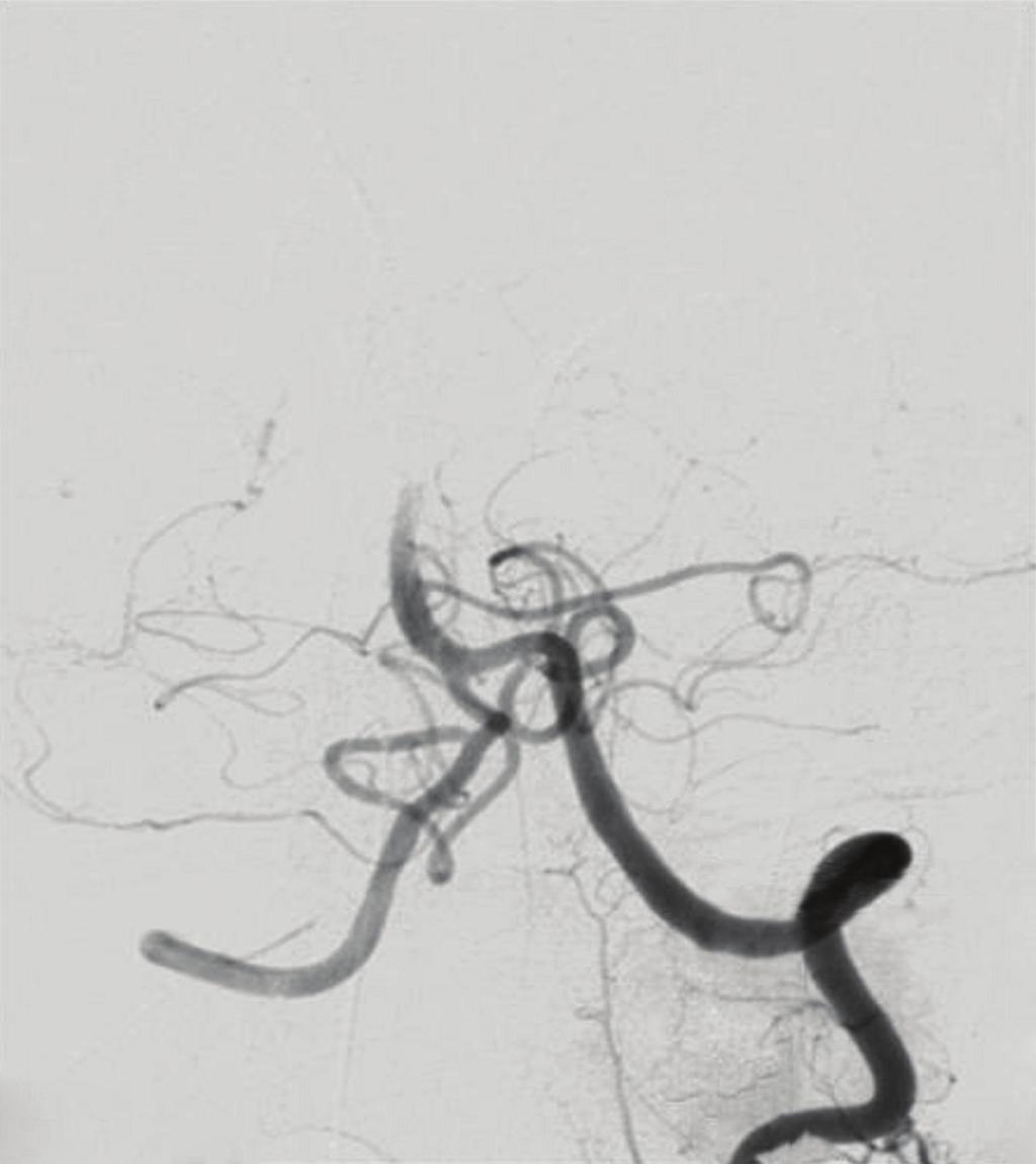 4 The Scientific World Journal Ventionem (a) (c) (b) (d) Figure 3: (a) Acute distal basilar artery occlusion, application of 1 mg IA rtpa without visible eﬀect; (b) passage of the thrombus with