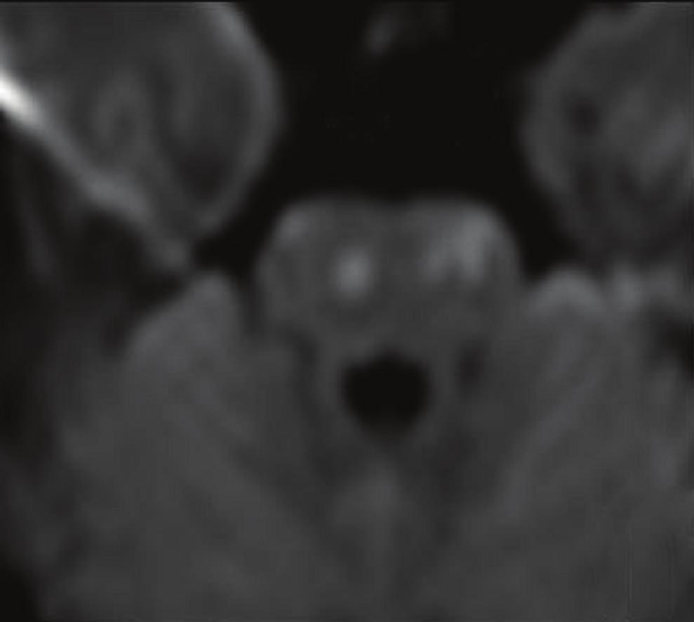 The Scientific World Journal 5 29 Figure 4: Very few DWI lesions in follow-up MRI 24 h after symptom onset in pons (white arrows) and in the right thalamus (black arrow) andnoneurologicaldeficit.