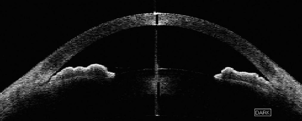 biomicroscopy image demonstrating plateau iris configuration