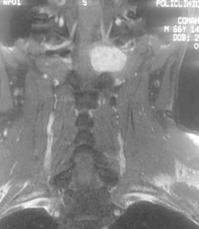 (Figure 1) Figure 1 - T1 MRI with contrast showing a large filling tumor extending laterally from the spinal canal, displacing