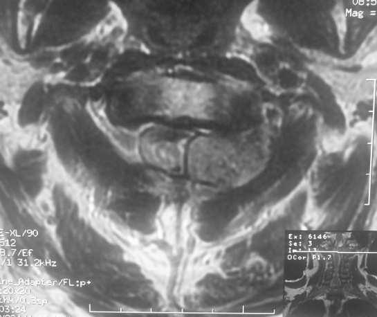 was highly vascularized, injected from the vertebral artery and the displacement and narrowing of the V3 portion of the vertebral