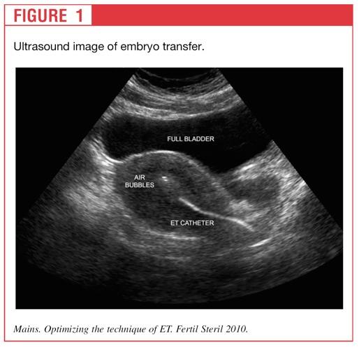 Ultrasound image of embryo transfer Mains.