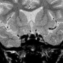 Craniopharyngioma CNS siderosis Black pituitary on T2*