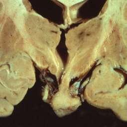 anomalies Polydactyly Imperforate anus Pathology Congenital