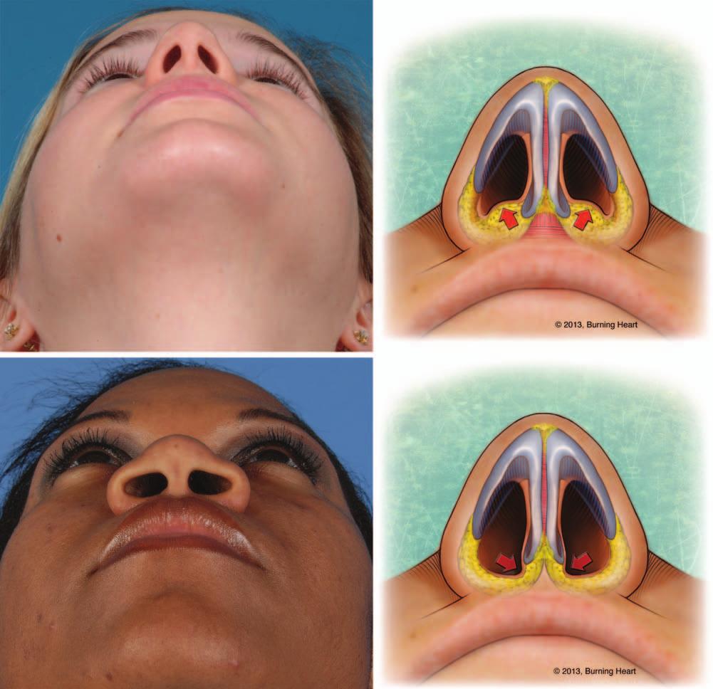 Plastic and Reconstructive Surgery April 2014 Fig. 5. (Above) Type IIIA deformity. Soft-tissue excess is primarily responsible for columellar distortion and may obstruct nasal inflow.