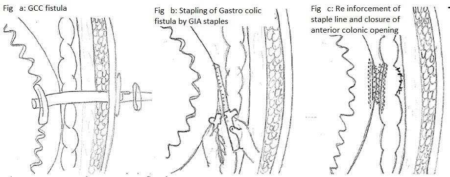 GCC fistula (B) Stapling of Gastro coloic fistula by GIA staples (C)