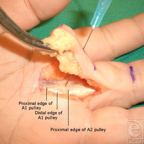 eplasty VOLUME 8 Figure 4. Exposure of the flexor sheath demonstrating complete division of the A1 pulley with preservation of the A2 pulley.