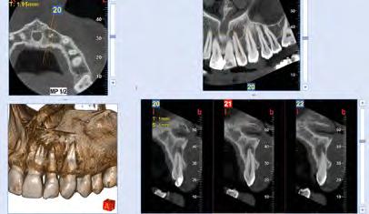 3D volumes with FOV from 4 x 4 cm and 16 x 18 cm and resolution up to 68 µm, the highest resolution available on the market, allow to assess maxillary sinuses, frontal sinuses, temporomandibular