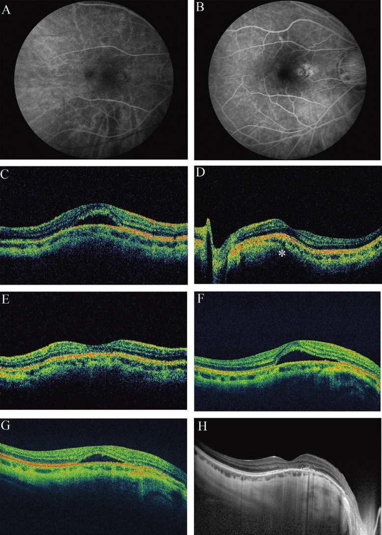 Case report-treatment with PDT Early (A) and late (B) fluorescein angiography images of the right eye show mild late leakage nasal to the fovea without definable choroidal neovascularization.
