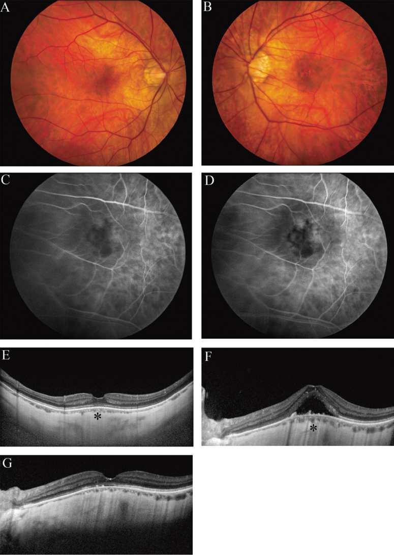 Case report-treatment with half-fluence verteporfin PDT Case 2. Fundus photographs of the right (A) and left (B) eye demonstrate absence of drusen and pigment mottling.