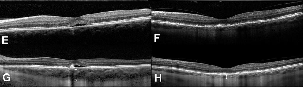 Central Serous Retinopathy - EDI OCT The conventional OCT scans before (E ) and 1 month after (F ) PDT show complete resolution of central serous retinal detachment.