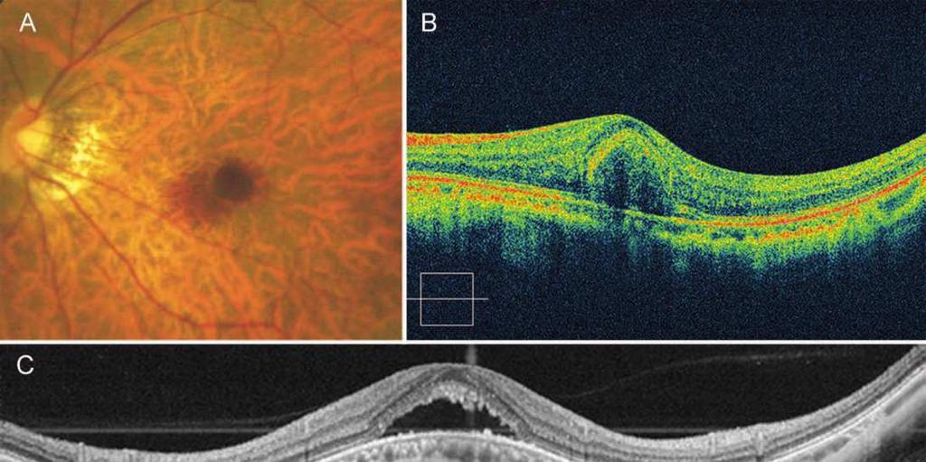Differential diagnosis for myopic choroidal