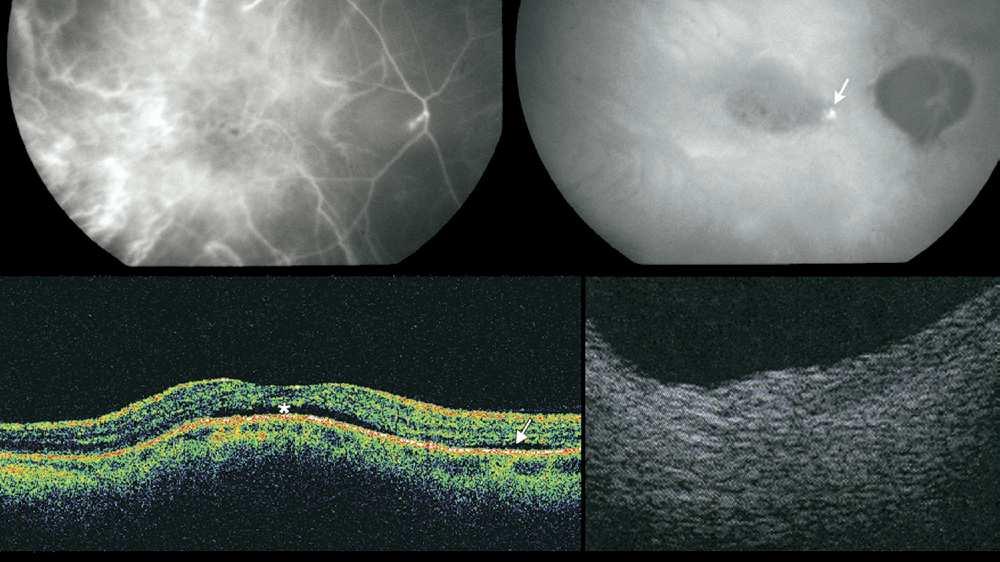 (Middle left) ICGA showing no sign of choroidal new vessels.