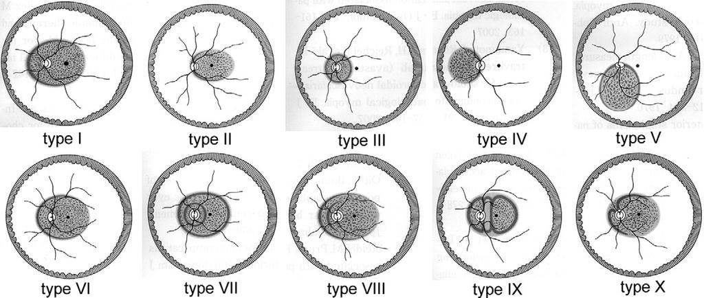 A staphyloma is defined as an abnormal local protrusion of thin sclera and uveal tissue and was categorized into 10 types by Curtin Drawings showing the classification of the