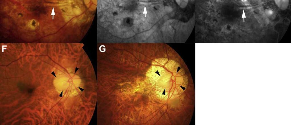1 - Macular pigmentation 2 - Ridge-like connection 3 - Oval optic disc The horizontal ridge is observed funduscopically as a yellowish-white linear lesion