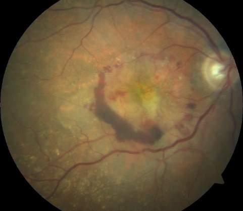VMA/VMT and Neovascular AMD VMA or VMT can decrease the effectiveness of anti-vegf treatment in patients with neovascular AMD The unfavorable effect