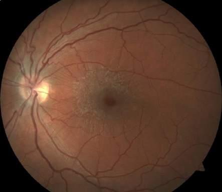 Epiretinal Membrane (ERM) AKA: macular pucker, cellophane maculopathy Fibrocellular proliferation found at the vitreoretinal interface made of up vitreous cortex remnants and glial cells Generally