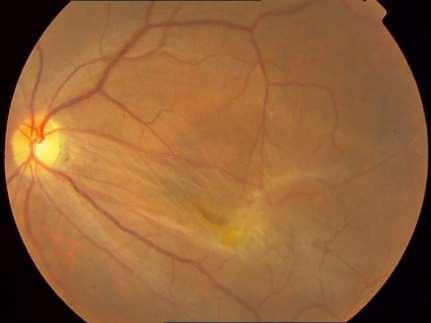 Diagnosis The normal foveal depression is often absent and the macula may develop cystoid spaces, lamellar macular hole, or even a full thickness hole.