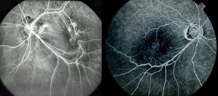 A fluorescein angiogram (FA) may be helpful to evaluate ERMs and/or VMT.