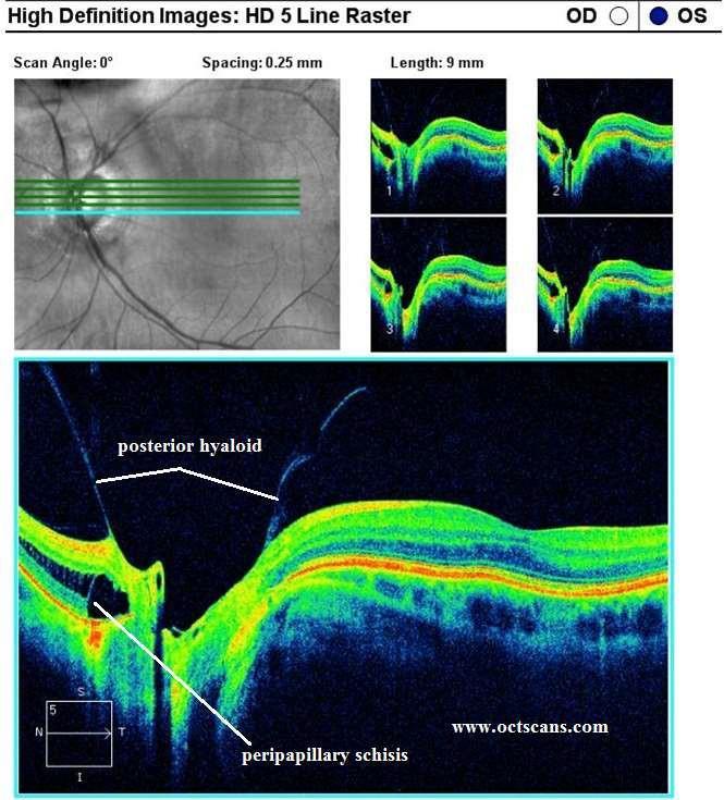 There is some recent suspicion that vitreopapillary traction might be associated with