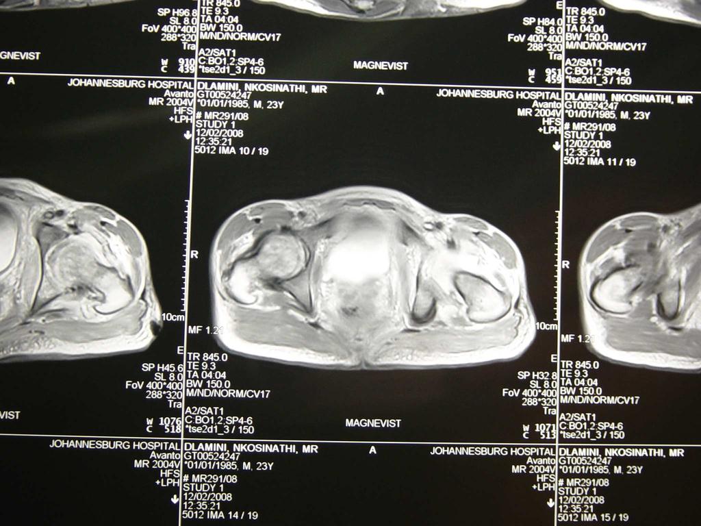 MRI Bony