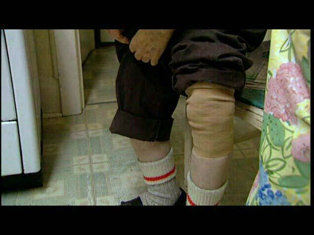 business Complains of cow-boy legs with painful