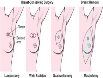 Surgical Options Lumpectomy/Partial Mastectomy/BCT Mastectomy Survival is