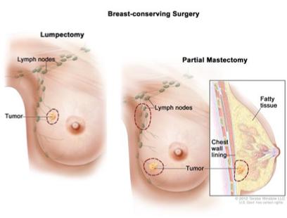 Breast-Conserving therapy BCT Lumpectomy Quadrectomy +