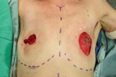 Simple Mastectomy A simple mastectomy (left) removes the