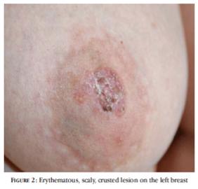 Paget s Disease Scaly skin lesion on nipple; biopsy shows Paget s cells Patients have DCIS or ductal CA in breast