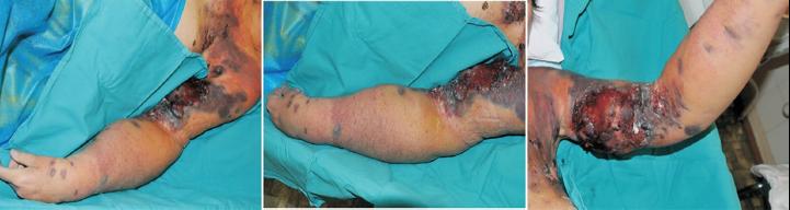 Stewart Treves Syndrome Lymphangiosarcoma from chronic lymphedema following axillary