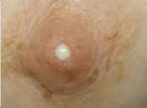 Nipple Discharge Most nipple discharge is benign All need a history, breast