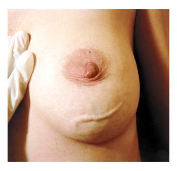 Mondor s Disease superficial vein thrombophlebitis of breast; feels cordlike, can be painful