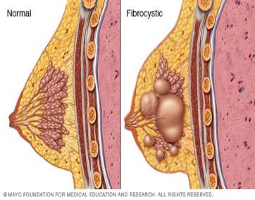 Fibrocystic Disease Lots of types: papillomatosis, sclerosing adenosis, apocrine metaplasia, duct adenosis, epithelial hyperplasia, ductal hyperplasia, and lobular hyperplasia Symptoms: breast pain,