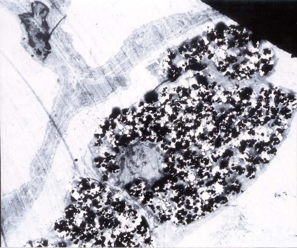 TEM of a lung section containing a highly phagocytic alveolar