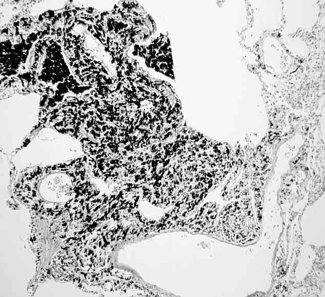 Light Micrograph of a human lung post mortem