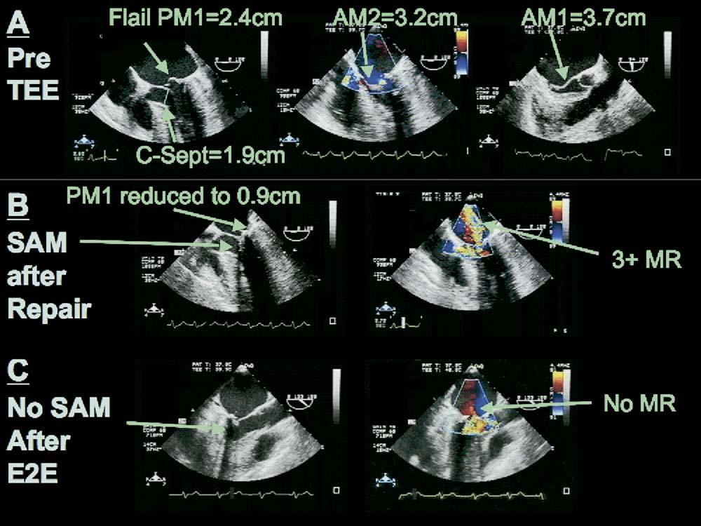 CARDIOVASCULAR 1614 BRINSTER ET AL Ann Thorac Surg EDGE-TO-EDGE TECHNIQUE IMPROVES OUTCOME OF MVR 2006;81:1612 7 Fig. 1. The SAM after mitral valve repair.