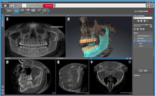 TRACK REAL MOTION IN MOTION THE DATA MERGED IN SICAT FUNCTION enables patient-specific three-dimensional presentation of the mandible in motion for the first time.