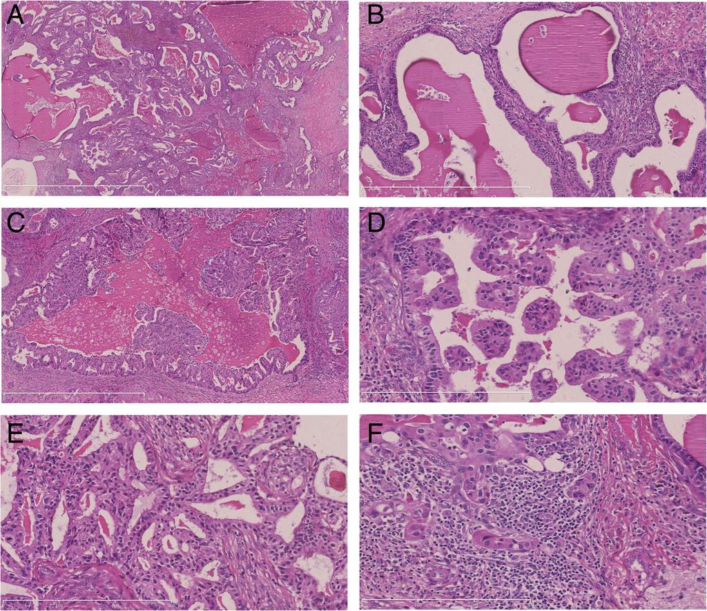 Sun et al. BMC Cancer (2019) 19:31 Page 3 of 5 gray-white solid areas. The individual cysts varied from 0.2 cm to 2.5 cm in dimension with cysts wall thickness from 0.1 cm to 0.5 cm. Hemorrhage and necrosis was evident.