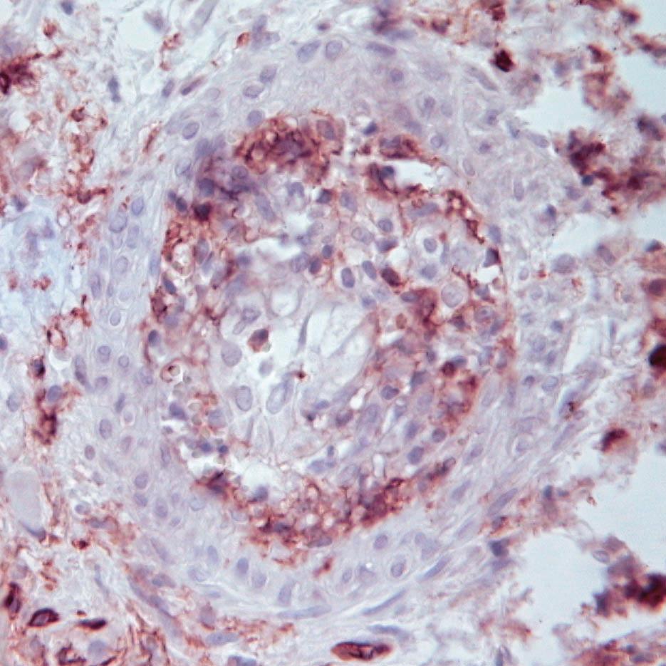 (B) Immunohistochemical staining of graft heart tissues for T-helper-cell marker CD4 at day 32 posttransplantation.